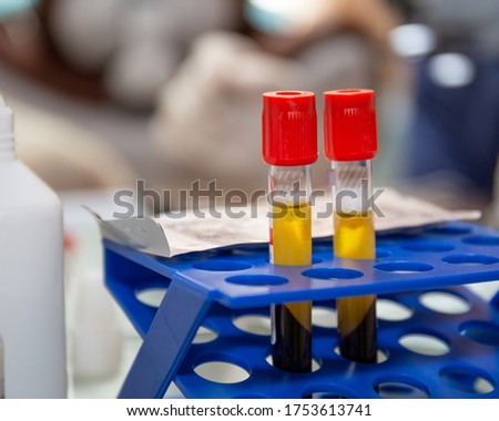 Two test-tubes with plazma in cells, prp laboratory with blur background