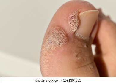 Two warts on a human thumb on a leg