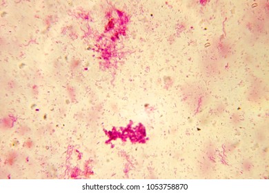 98 Types tuberculosis Stock Photos, Images & Photography | Shutterstock