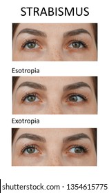 Types Of Strabismus. Esotropia And Exotropia