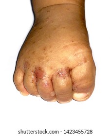 Typical or characteristic scabies infestation at toes, toe webs and dorsum of right foot in eight month old infant. Scabies is caused by Sarcoptes scabiei.