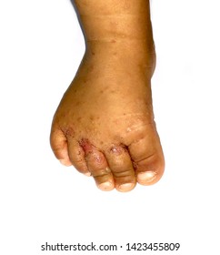 Typical or characteristic scabies infestation at toes, toe webs and dorsum of right foot in eight month old infant. Scabies is caused by Sarcoptes scabiei.