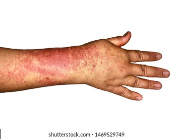 Purpura Disease High Res Stock Images Shutterstock