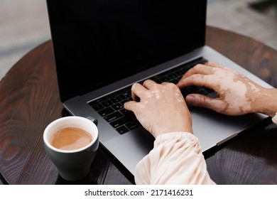 Typing Text On Laptop. Hands With Vitiligo Pigmentation Seasonal Skin Disease. Working Online. Lifestyle With Vitiligo