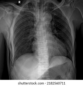 Ubcutaneous Emphysema Chest X Ray , Subcutaneous Emphysema Refers To Presence Of Air In The Loose Subcutaneous Tissue And Muscle