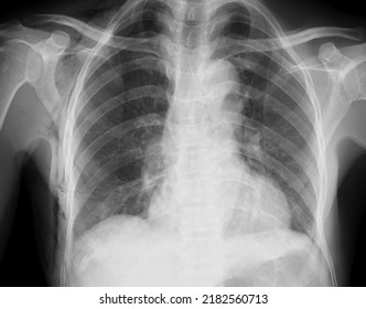 Ubcutaneous Emphysema Chest X Ray , Subcutaneous Emphysema Refers To Presence Of Air In The Loose Subcutaneous Tissue And Muscle