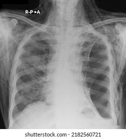 Ubcutaneous Emphysema Chest X Ray , Subcutaneous Emphysema Refers To Presence Of Air In The Loose Subcutaneous Tissue And Muscle