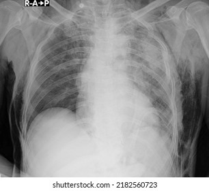 Ubcutaneous Emphysema Chest X Ray , Subcutaneous Emphysema Refers To Presence Of Air In The Loose Subcutaneous Tissue And Muscle