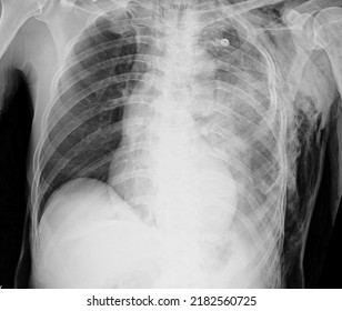 Ubcutaneous Emphysema Chest X Ray , Subcutaneous Emphysema Refers To Presence Of Air In The Loose Subcutaneous Tissue And Muscle