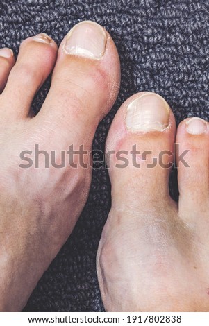 ugly female toenails with cracks
