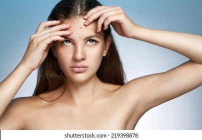 Ugly problem skin girl. Woman skin care concept. Photo of Latina girl on blue background 