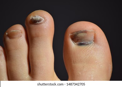 Ingrown Toenail Images, Stock Photos & Vectors | Shutterstock