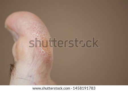 Ugly toe of a man with hair and the need for medical pedicure and healthcare
