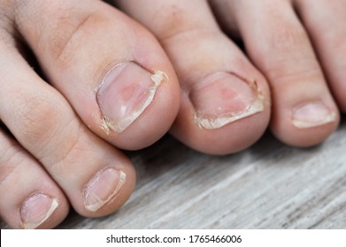 Ugly Deformed Foot Toenail Images, Stock Photos & Vectors | Shutterstock