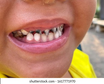 Bad Black Teeth Child Stock Photos Images Photography Shutterstock