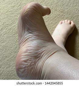 Mature wrinkled soles