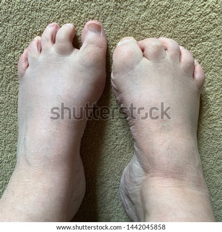 UK - Hollow feet showing high arches, short metatarsal syndrome and retracted toes.