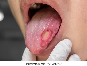 Ulcer At The Tongue Of Asian Male Patient. Diagnosis May Be Aphthous Ulcer, Canker Sore, Stress Ulcer Or Tongue Cancer.