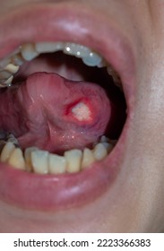 Ulcer At The Tongue Of Asian Male Patient. Diagnosis May Be Aphthous Ulcer, Canker Sore, Stress Ulcer Or Tongue Cancer.