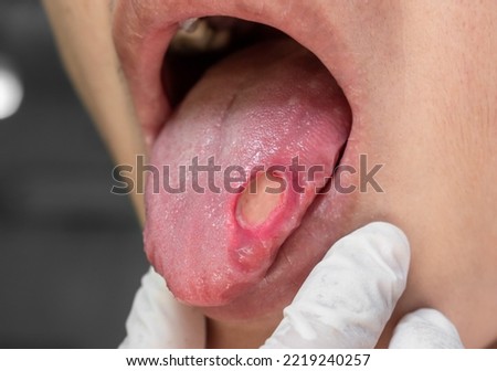 Ulcer at the tongue of Asian male patient. Diagnosis may be aphthous ulcer, canker sore, stress ulcer or tongue cancer.