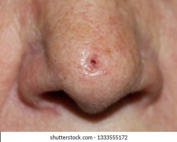 Ulcerated basal cell carcinoma on the nose of an elderly woman.