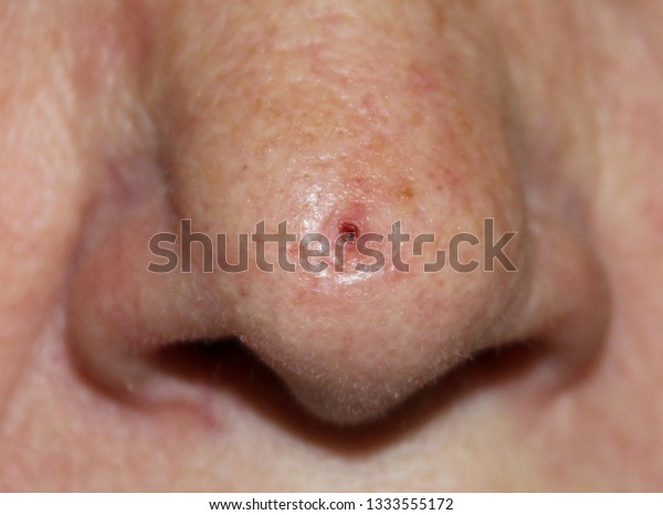 Ulcerated Basal Cell Carcinoma On Nose Stock Photo Edit Now