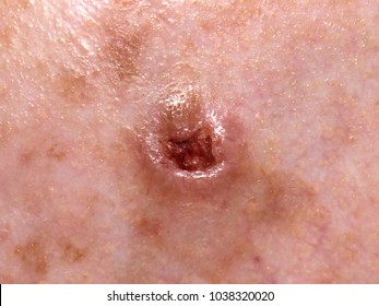 Ulcerated nodular basal cell carcinoma on a forehead of an elderly man.