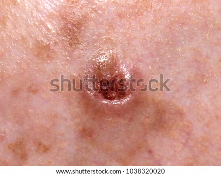 Ulcerated nodular basal cell carcinoma on a forehead of an elderly man.