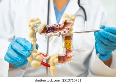 Ulcerative Colitis. Intestine, appendix and digestive system, doctor holding anatomy model for study diagnosis and treatment in hospital.