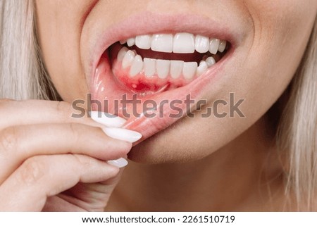 Ulcerative stomatitis on the gums. Gum inflammation. Close up of young blonde woman showing red bleeding gingiva with an ulcer holding her lip. Dentistry, dental care, lesion