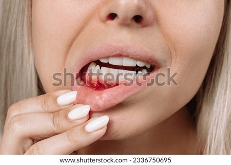 Ulcerative stomatitis on the gums. Gum inflammation. Close up of young blonde woman showing red bleeding gingiva with an ulcer holding her lip. Dentistry, dental care, painful lesion