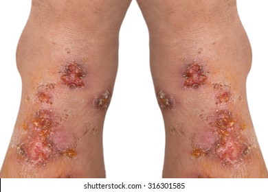 Ulcers infection on the feet boy isolated on white background
