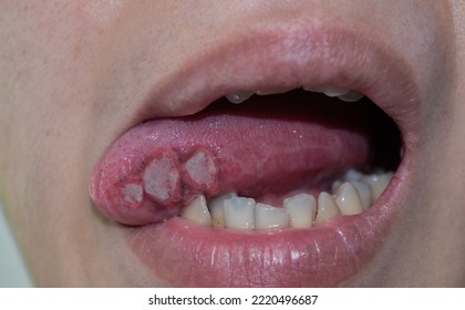 Ulcers At The Tongue Of Asian Male Patient. Diagnosis May Be Aphthous Ulcer, Canker Sore, Stress Ulcer Or Tongue Cancer.