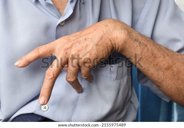 Ulnar claw hand of Asian elder man. also\
known as spinster claw. develops due to ulnar nerve damage causing\
weakness of the\
lumbricals.