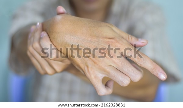 Ulnar claw hand of Asian young man. also\
known as spinster claw. develops due to ulnar nerve damage causing\
weakness of the\
lumbricals.
