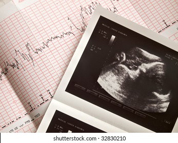 ultrasonic portrait of the fetus and cardiogram results