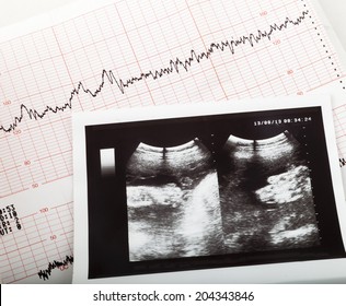 ultrasonic result of the fetus and cardiogram