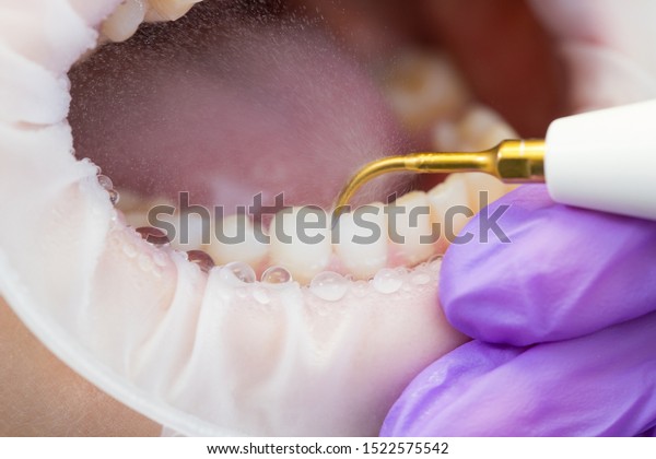 Ultrasonic teeth cleaning, close-up. Removal\
of tartar, plaque. Paradontitis,\
paradantoz.