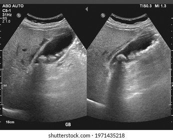 Ultrasonography Image Of Gallbladder With Gall Stones At Upper Abdomen