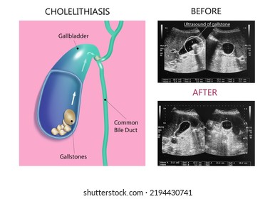 Ultrasonography Image Of Gallbladder With Gall Stones At Upper Abdomen. Gallstones Concept - Anatomy Of Cholelithiasis