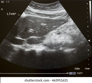 Ultrasound Abdomen Showing Liver