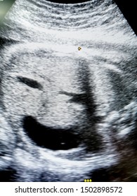 Ultrasound of abdomen shows weird unexpected human face like sonograph smiling to the investigator . weird photo . Medical and healthcare concept . weird medicine. weird photo.