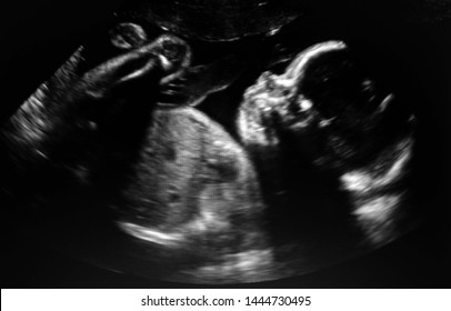 Ultrasound baby in a mother's womb.                             
