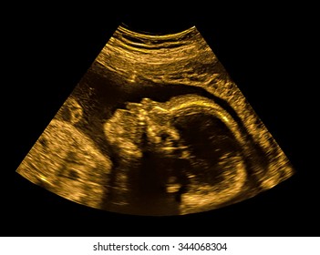 ultrasound of baby in pregnant woman