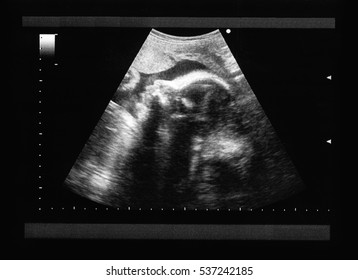 ultrasound of baby in pregnant woman