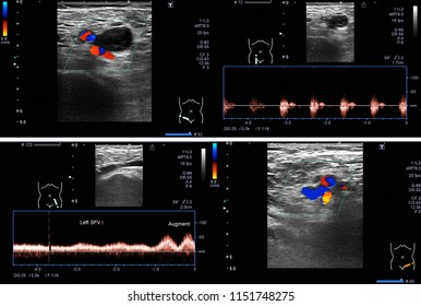 ULTRASOUND COLOR DOPPLER : Acute DVT Of Right Iliac Vein,right Superficical Femoral Vein And Right Popliteal Vein.