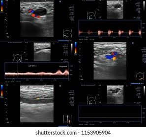 ULTRASOUND COLOR DOPPLER : Acute DVT Of Right Iliac Vein,right Superficical Femoral Vein And Right Popliteal Vein.