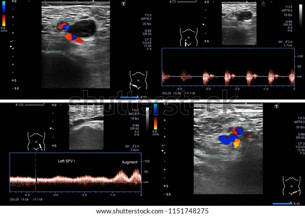 Ultrasound Color Doppler Acute Dvt Right Stock Photo (Edit Now) 1151748275