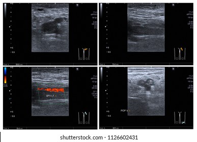 Ultrasound Color Doppler Left Leg:Hyperechoic Thrombus With Dilatation Of Veins, At Lt.superficial Femoral V. And Popliteal V. Impression: Acute DVT Of Lt Leg.