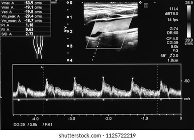 Ultrasound doppler of carotid artery